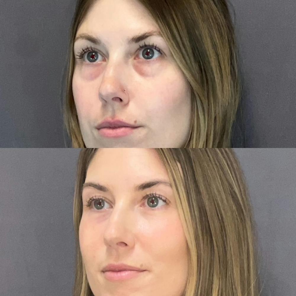Lower Blepharoplasty Before & After Gallery - Patient 132321 - Image 3