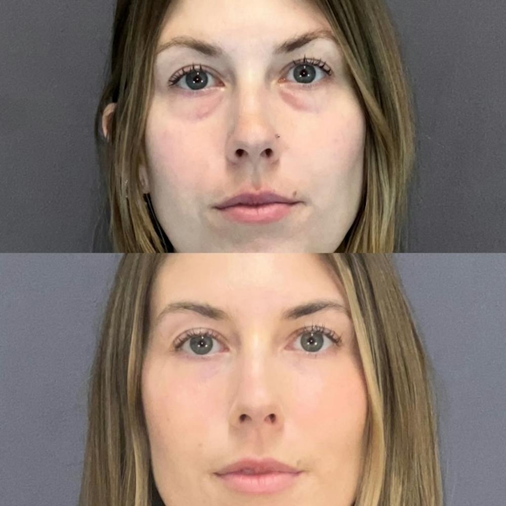 Lower Blepharoplasty Before & After Gallery - Patient 132321 - Image 1
