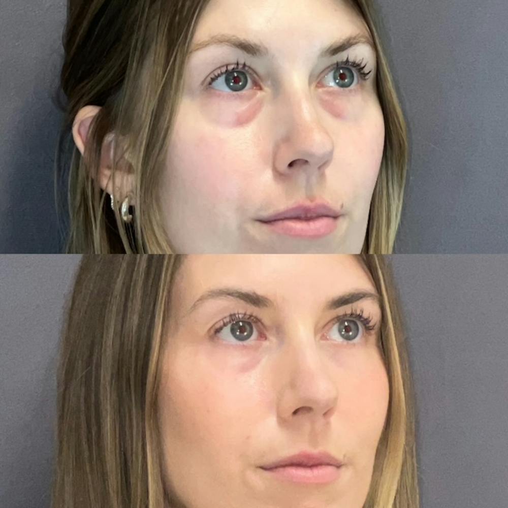 Lower Blepharoplasty Before & After Gallery - Patient 132321 - Image 2
