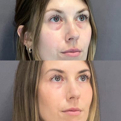Lower Blepharoplasty Before & After Gallery - Patient 132321 - Image 2