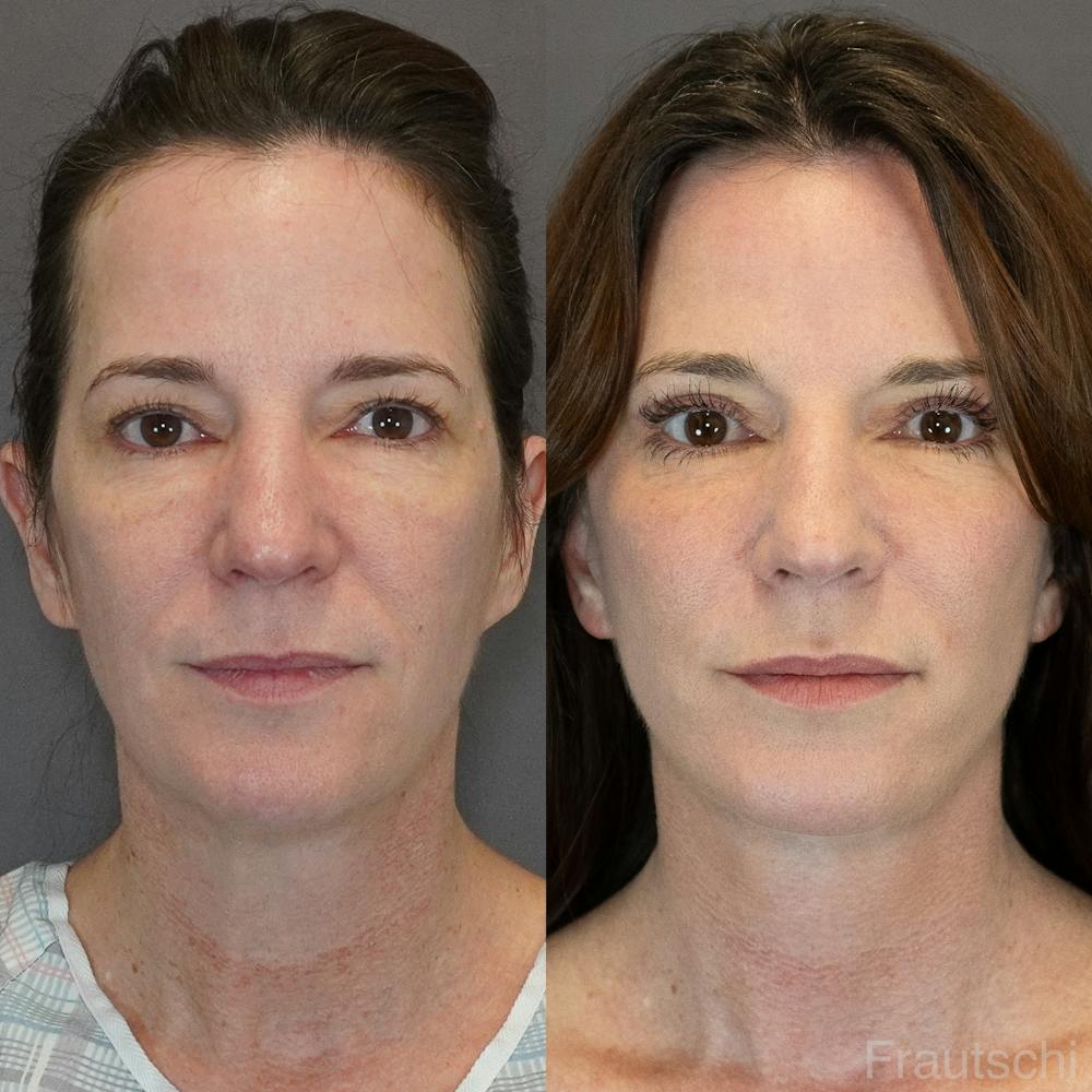 Necklift Before & After Gallery - Patient 852274 - Image 1