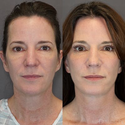 Necklift Before & After Gallery - Patient 852274 - Image 1