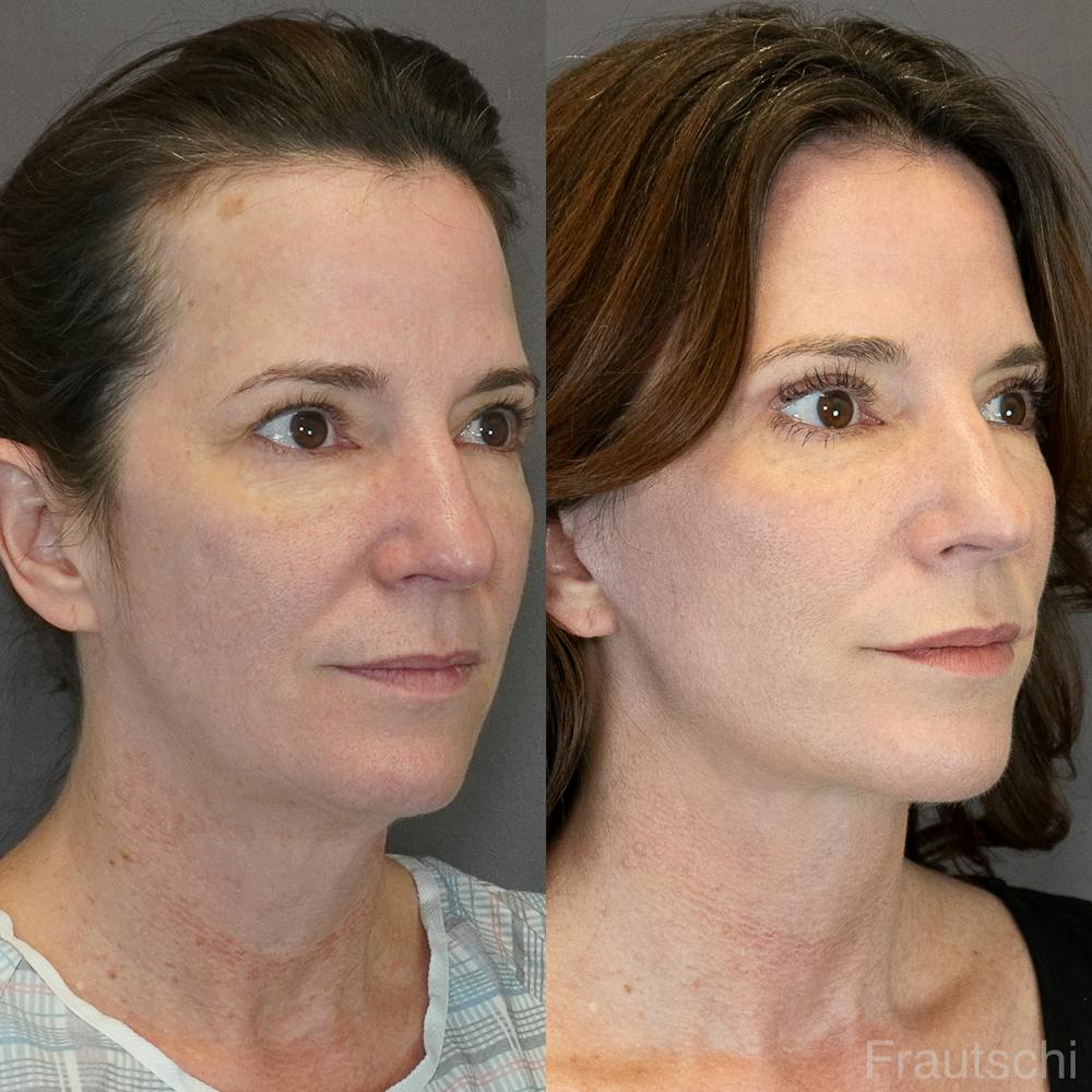 Necklift Before & After Gallery - Patient 852274 - Image 5