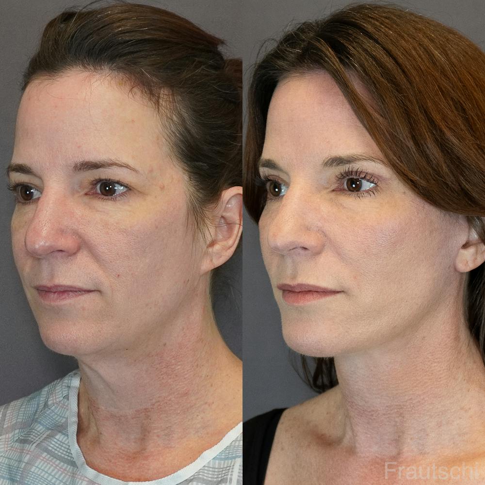 Necklift Before & After Gallery - Patient 852274 - Image 2