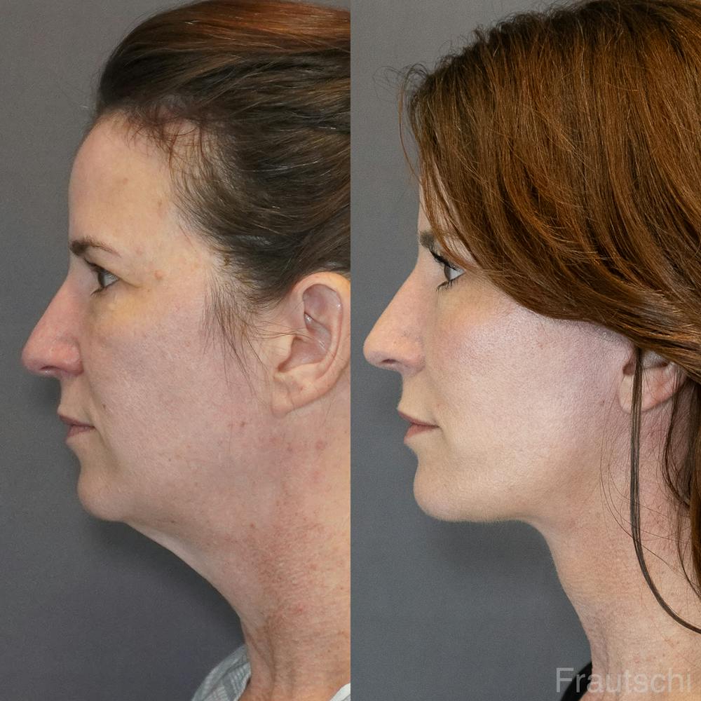 Necklift Before & After Gallery - Patient 852274 - Image 3