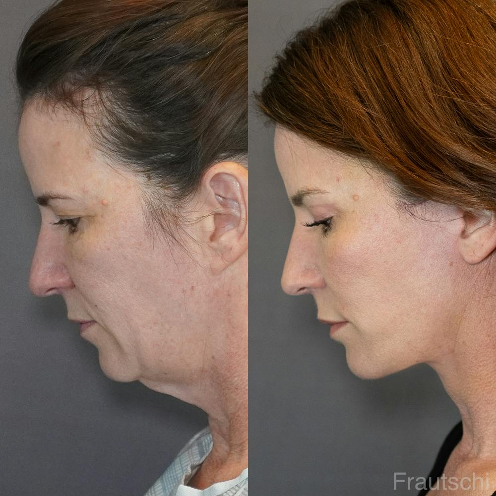 Necklift Before & After Gallery - Patient 852274 - Image 4