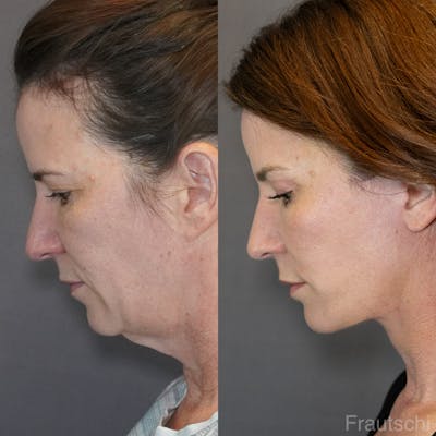 Necklift Before & After Gallery - Patient 852274 - Image 4
