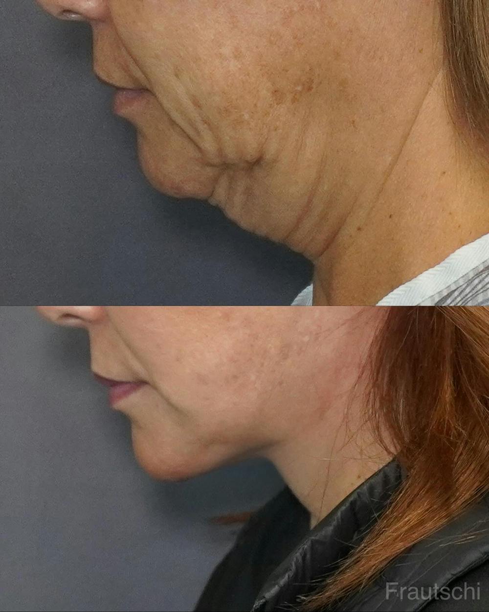 Necklift Before & After Gallery - Patient 269590 - Image 1
