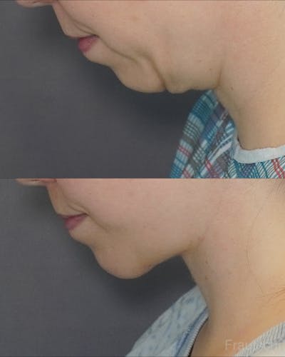 Necklift Before & After Gallery - Patient 102728 - Image 1