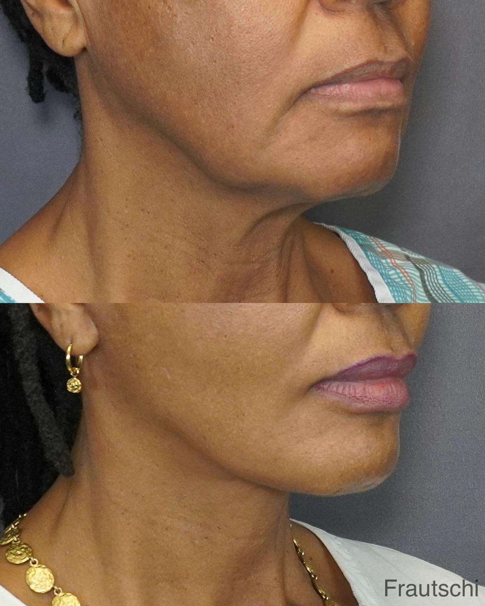 Necklift Before & After Gallery - Patient 483963 - Image 1