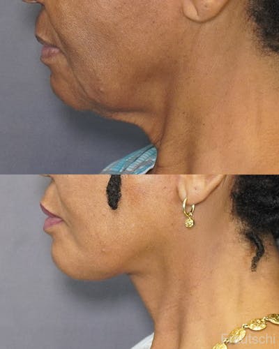 Necklift Before & After Gallery - Patient 483963 - Image 2