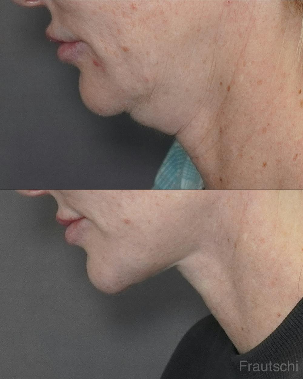 Facelift Before & After Gallery - Patient 358638 - Image 1