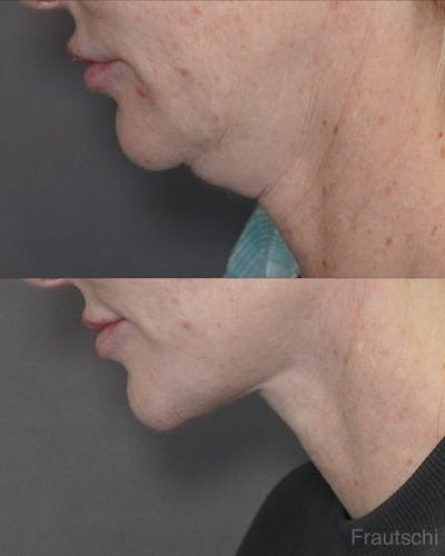 Necklift Before & After Gallery - Patient 223209 - Image 1