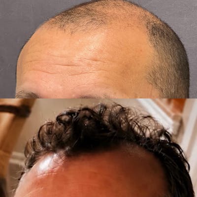 Hair Restoration  Before & After Gallery - Patient 406001 - Image 1