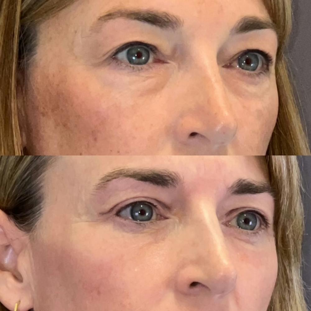 Lower Blepharoplasty Before & After Gallery - Patient 227558 - Image 3