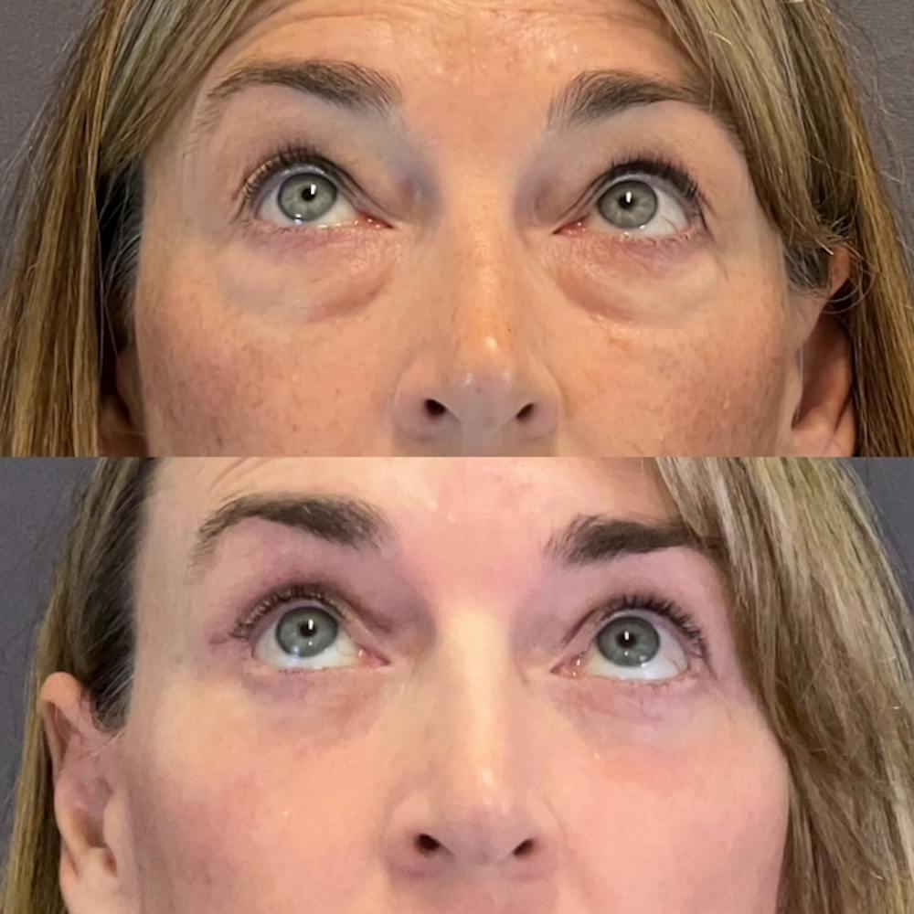 Lower Blepharoplasty Before & After Gallery - Patient 227558 - Image 2