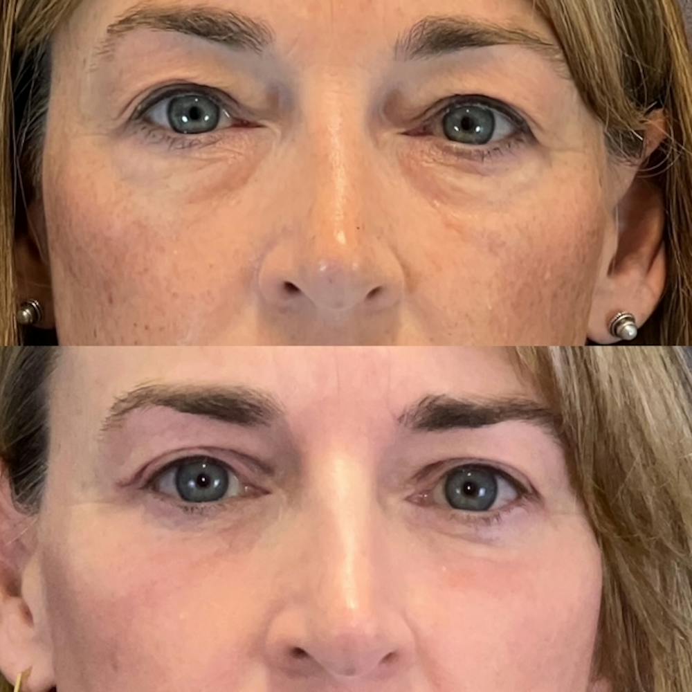 Lower Blepharoplasty Before & After Gallery - Patient 227558 - Image 1