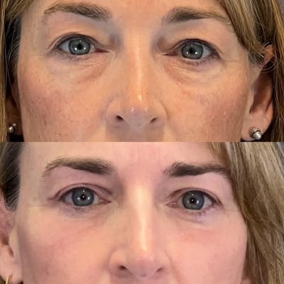 Lower Blepharoplasty Before & After Gallery - Patient 227558 - Image 1