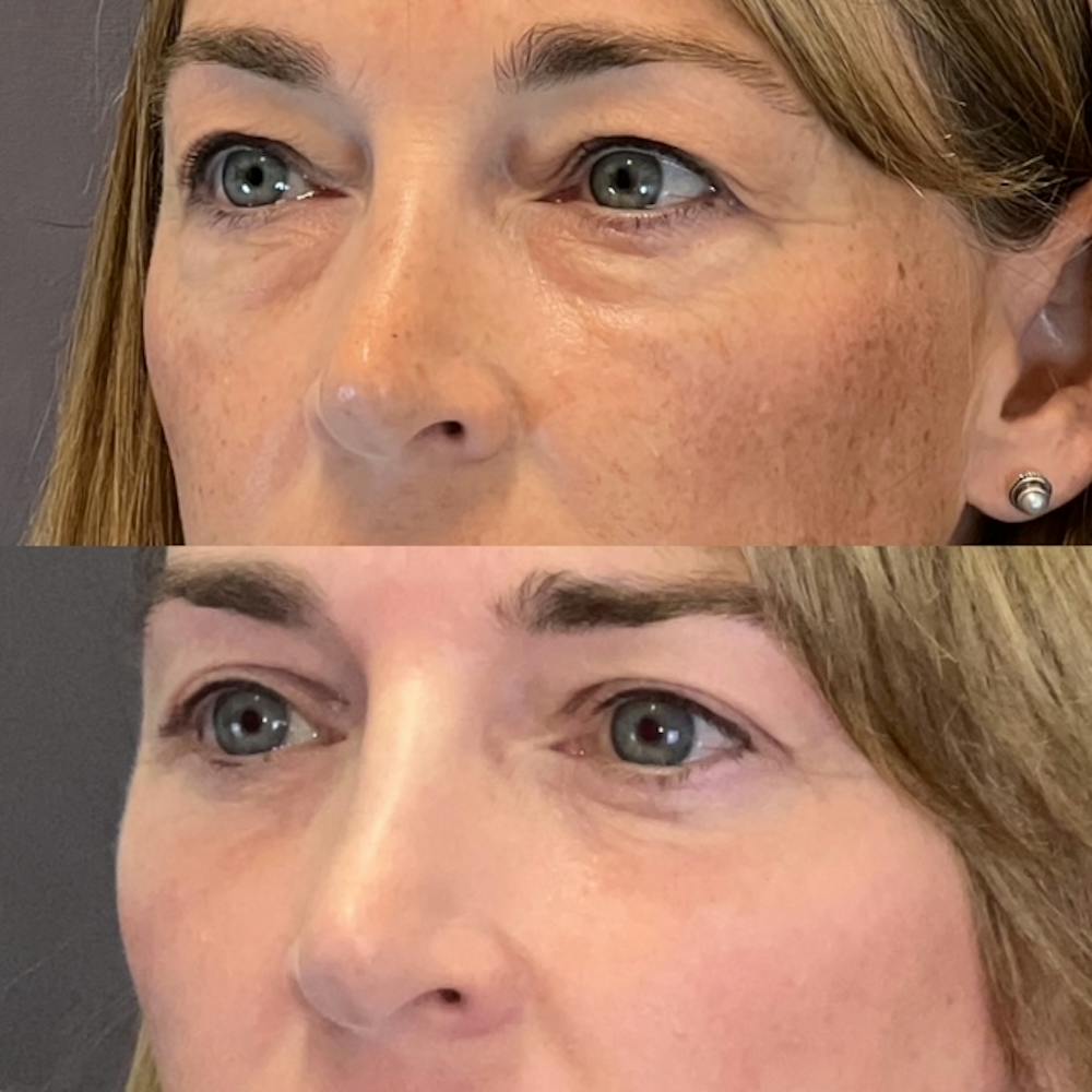 Lower Blepharoplasty Before & After Gallery - Patient 227558 - Image 4