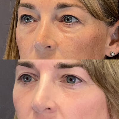 Lower Blepharoplasty Before & After Gallery - Patient 227558 - Image 4