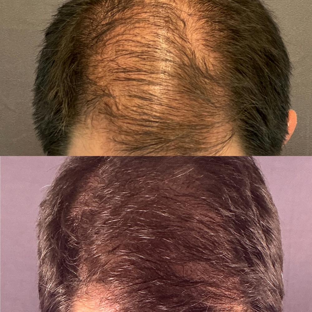 Hair Restoration  Before & After Gallery - Patient 330147 - Image 1