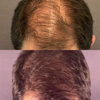 Hair Restoration  Before & After Gallery - Patient 332382 - Image 1
