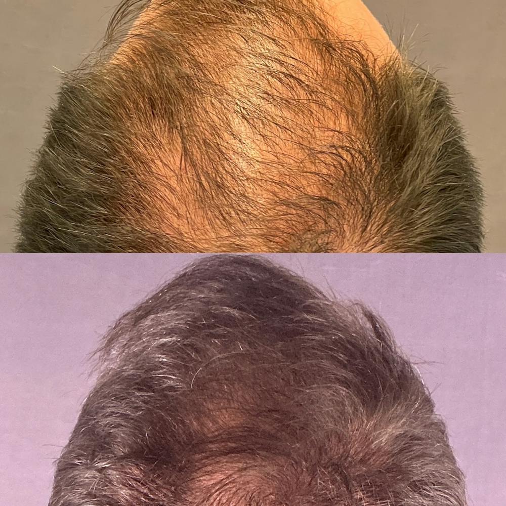 Hair Restoration  Before & After Gallery - Patient 330147 - Image 2