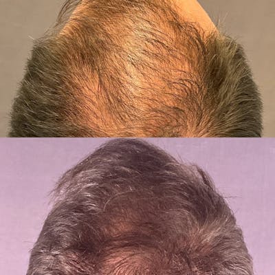 Hair Restoration  Before & After Gallery - Patient 330147 - Image 2