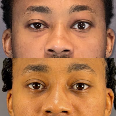 Lower Blepharoplasty Before & After Gallery - Patient 313024 - Image 1