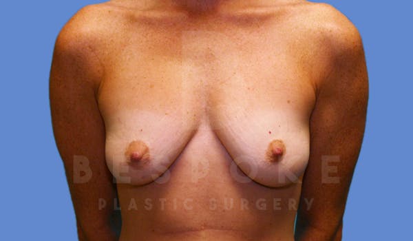 Breast Augmentation Before & After Gallery - Patient 4600002 - Image 1