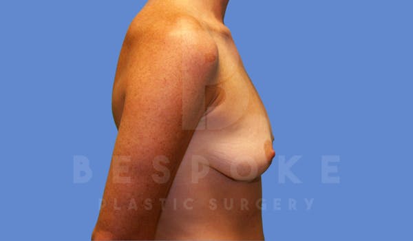 Breast Augmentation Before & After Gallery - Patient 4600002 - Image 3