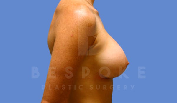Breast Augmentation Before & After Gallery - Patient 4600002 - Image 4