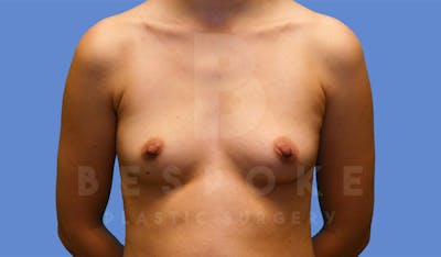 Breast Augmentation Before & After Gallery - Patient 4600003 - Image 1
