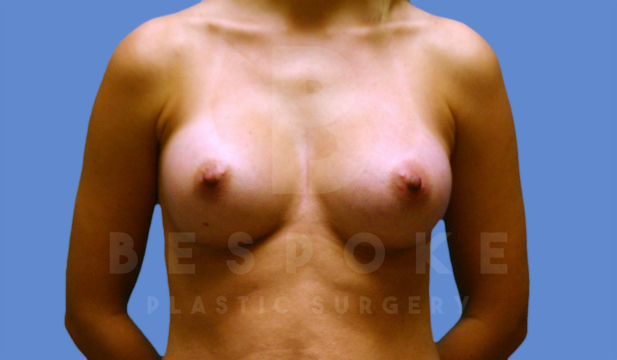 Breast Augmentation Gallery - Patient 4600003 - Image 2