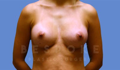 Breast Augmentation Before & After Gallery - Patient 4600003 - Image 2