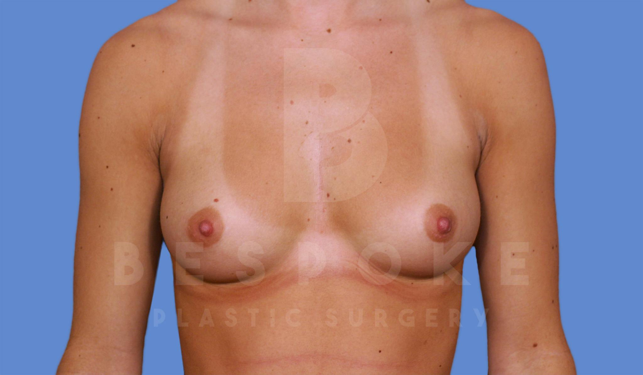 Breast Augmentation Before & After Gallery - Patient 4600004 - Image 1
