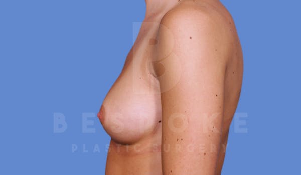 Breast Augmentation Gallery - Patient 4600004 - Image 3