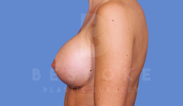 Breast Augmentation Before & After Gallery - Patient 4600004 - Image 4