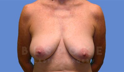 Breast Lift With Implants Before & After Gallery - Patient 4600007 - Image 1