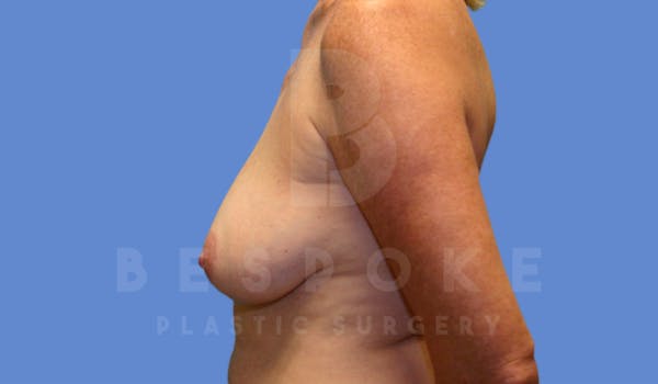 Breast Lift With Implants Gallery - Patient 4600007 - Image 3