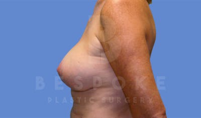 Breast Lift With Implants Before & After Gallery - Patient 4600007 - Image 4