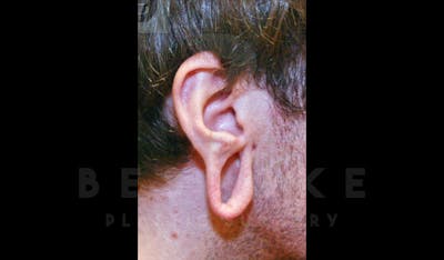 Ear lobe Contouring Before & After Gallery - Patient 4600010 - Image 1
