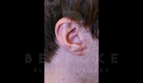 Ear lobe Contouring Before & After Gallery - Patient 4600010 - Image 2
