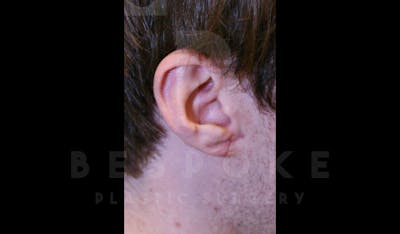 Ear lobe Contouring Before & After Gallery - Patient 4600010 - Image 2