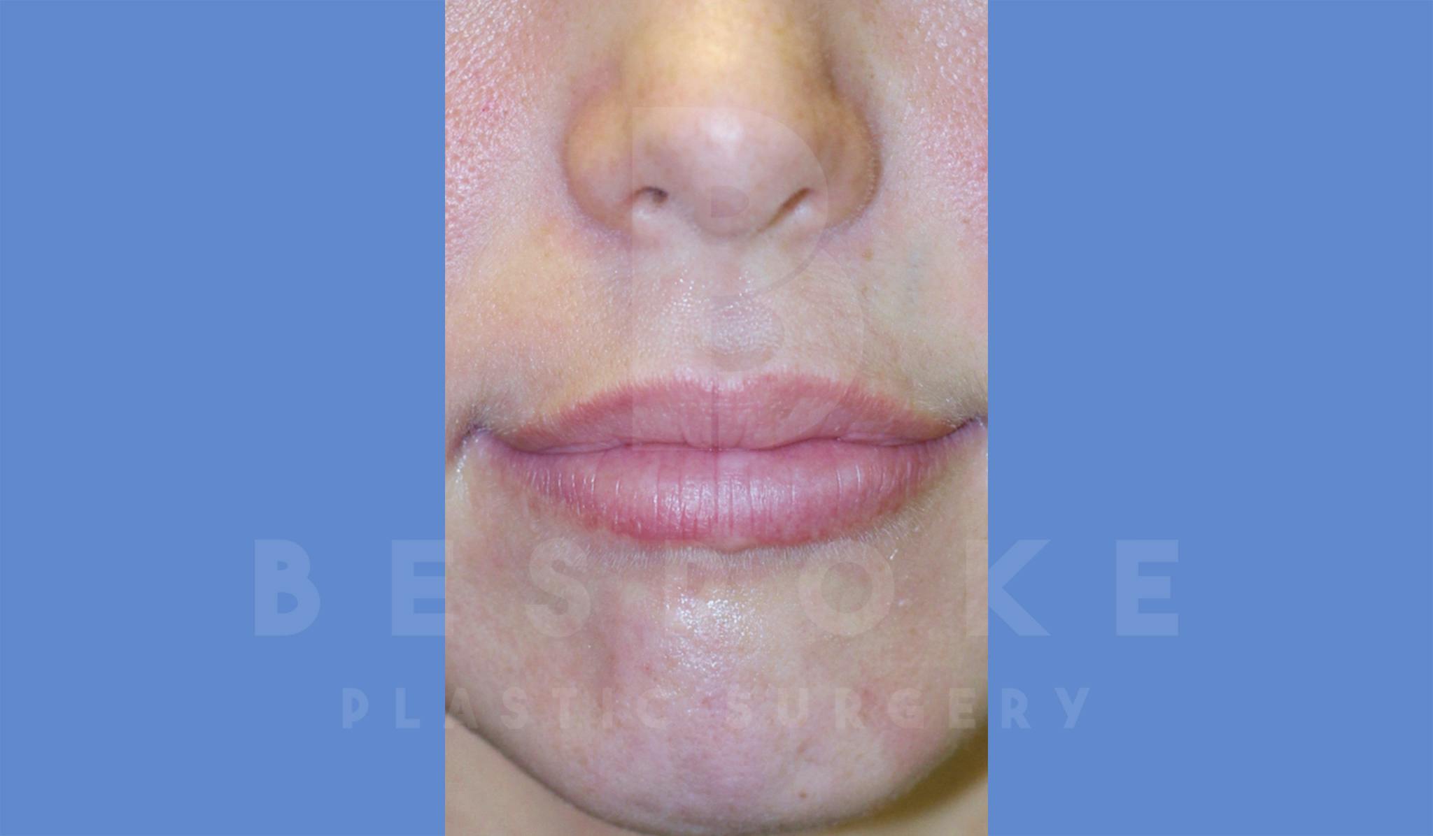 Fillers Before & After Gallery - Patient 4600012 - Image 1
