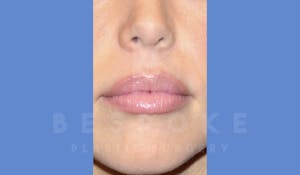 Dermal Fillers