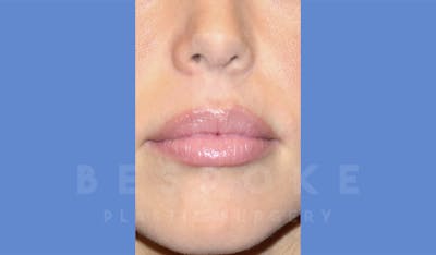 Fillers Before & After Gallery - Patient 4600012 - Image 2