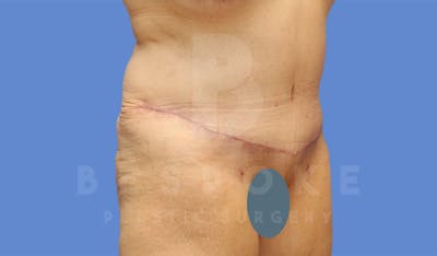 Extended Tummy Tuck Before & After Gallery - Patient 182449 - Image 4