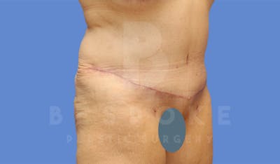 Tummy Tuck Before & After Gallery - Patient 4600015 - Image 4