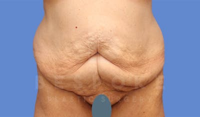 Tummy Tuck Before & After Gallery - Patient 4600015 - Image 1
